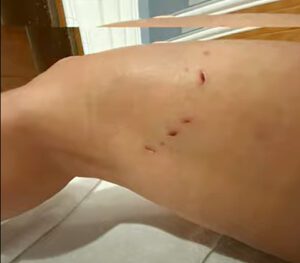 Wing-foil rider bitten by shark in Anna Maria